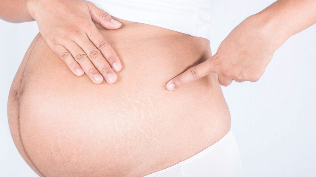 pregnancy stretch marks stretch mark prevention