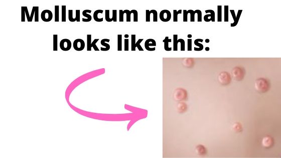 Molluscum contagiosum