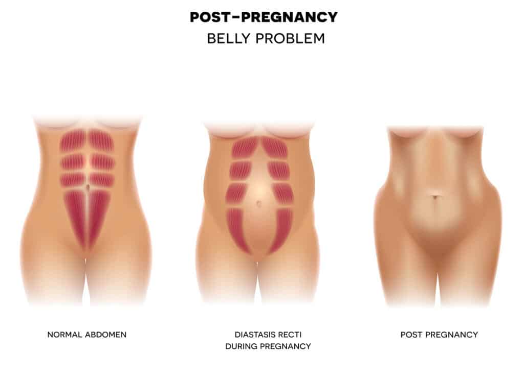 Pictures of diastasis recti Diastasis Recti pictures
