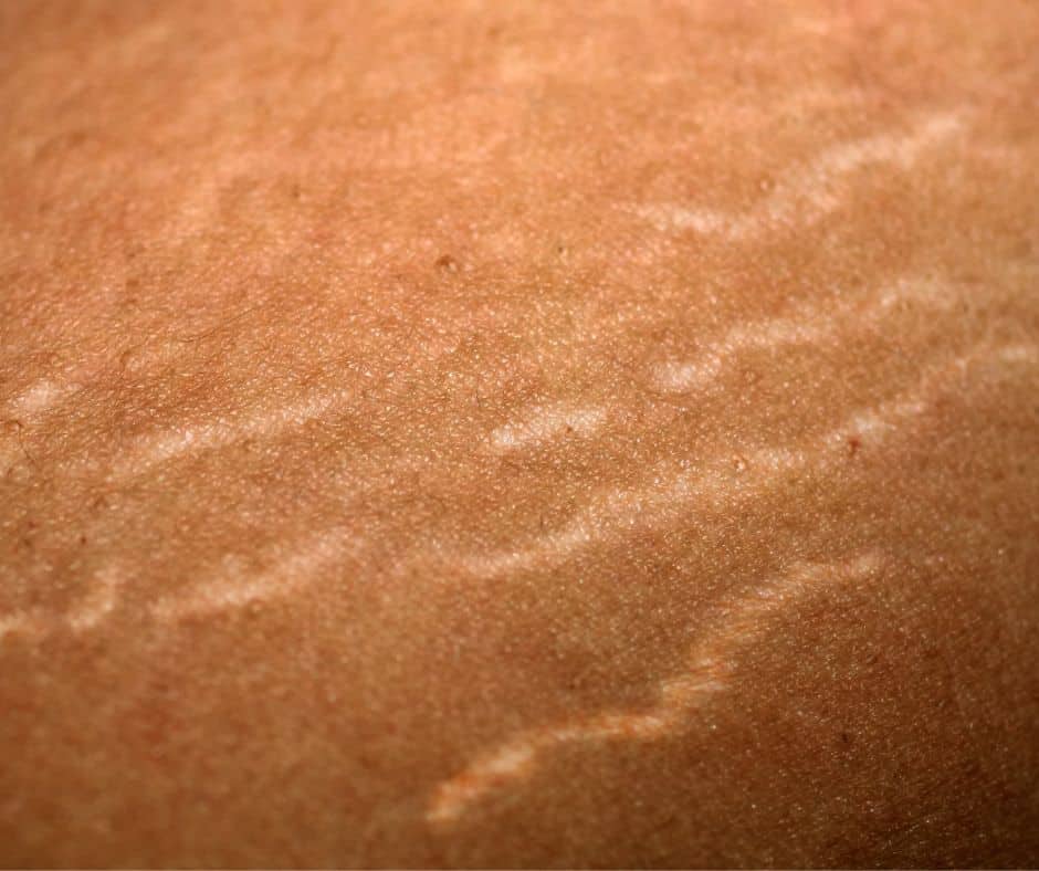 white stretch marks on dark skin