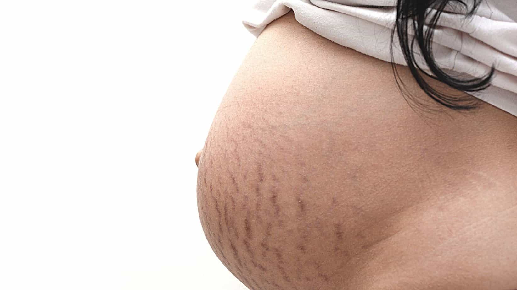 pregnancy marks on belly from skin stretching