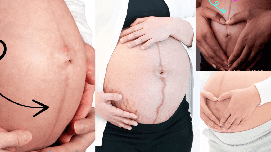 Pregnant belly line, Linea alba, Linea Nigra